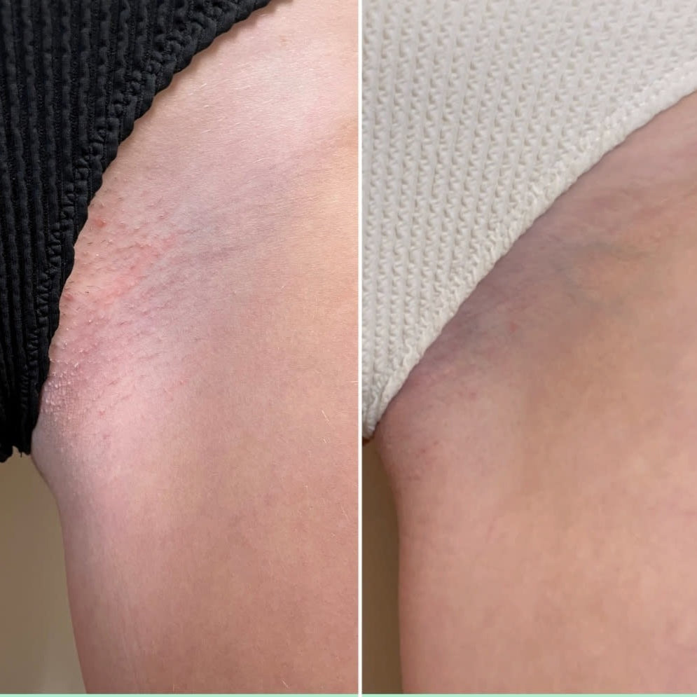 Smooth skin shouldn't come with bumps attached.